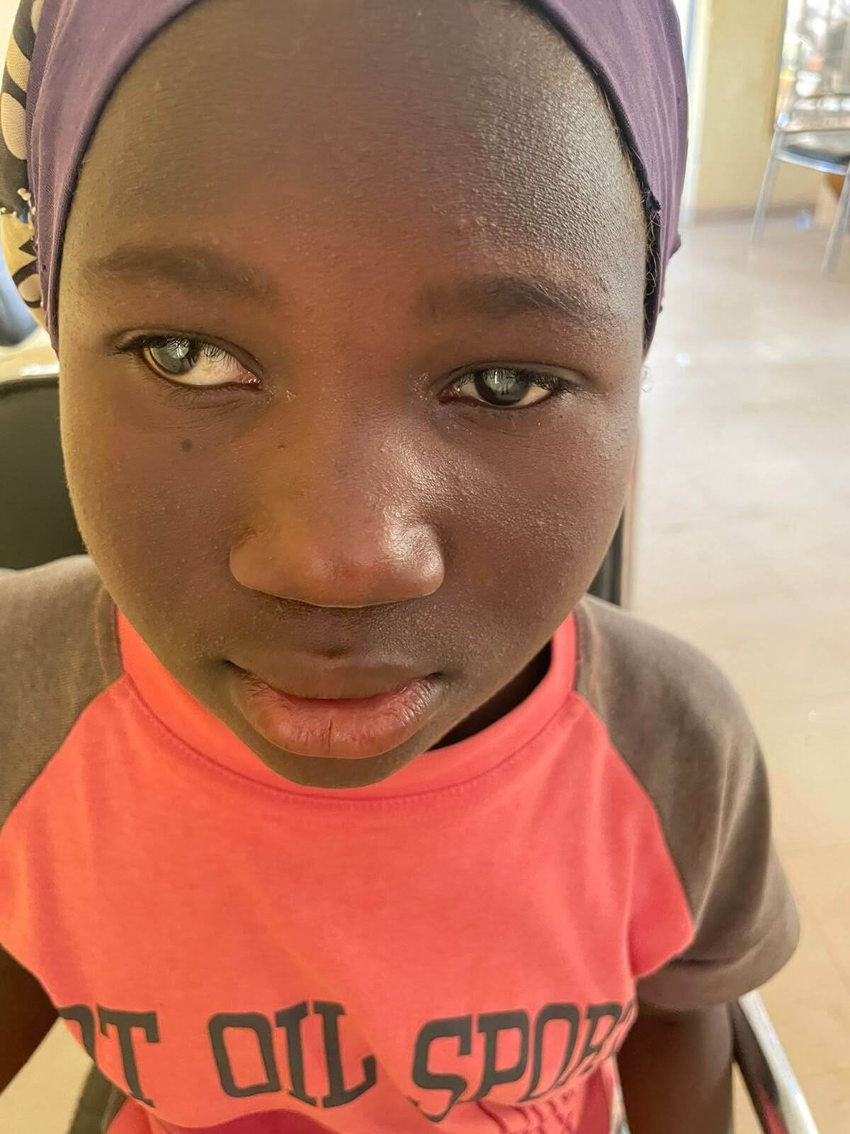 Cataracts in Mali: A Preventable Crisis with a Simple Solution